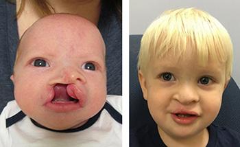 Before and after photo of a child born with a craniofacial disorder