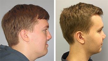 Craniofacial Center patient before and after photo