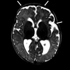 MRI image showing fluid between the brain and the skull