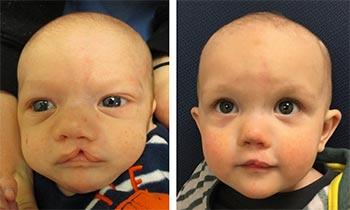Craniofacial Center patient before and after photo